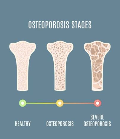 osteoporosis - when to get scanned